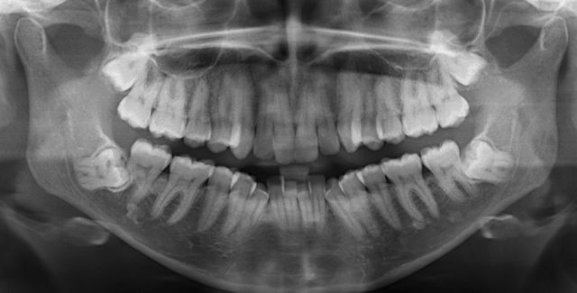 生活 生活百科 在美国看牙医你一定要了解的二三事  最后终于因为智齿